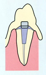 マグネット式入れ歯の構造