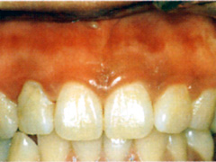 歯茎の黒ずみ
